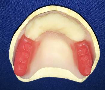 ナイトガード用総義歯